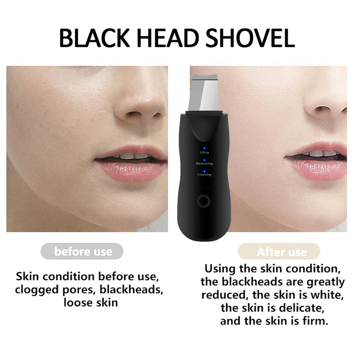 Ultrasonic Skin Scrubber + Best Blackhead Remover Package